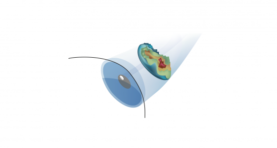 Femto-Lasik1