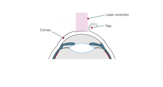 LASIK_EN_3