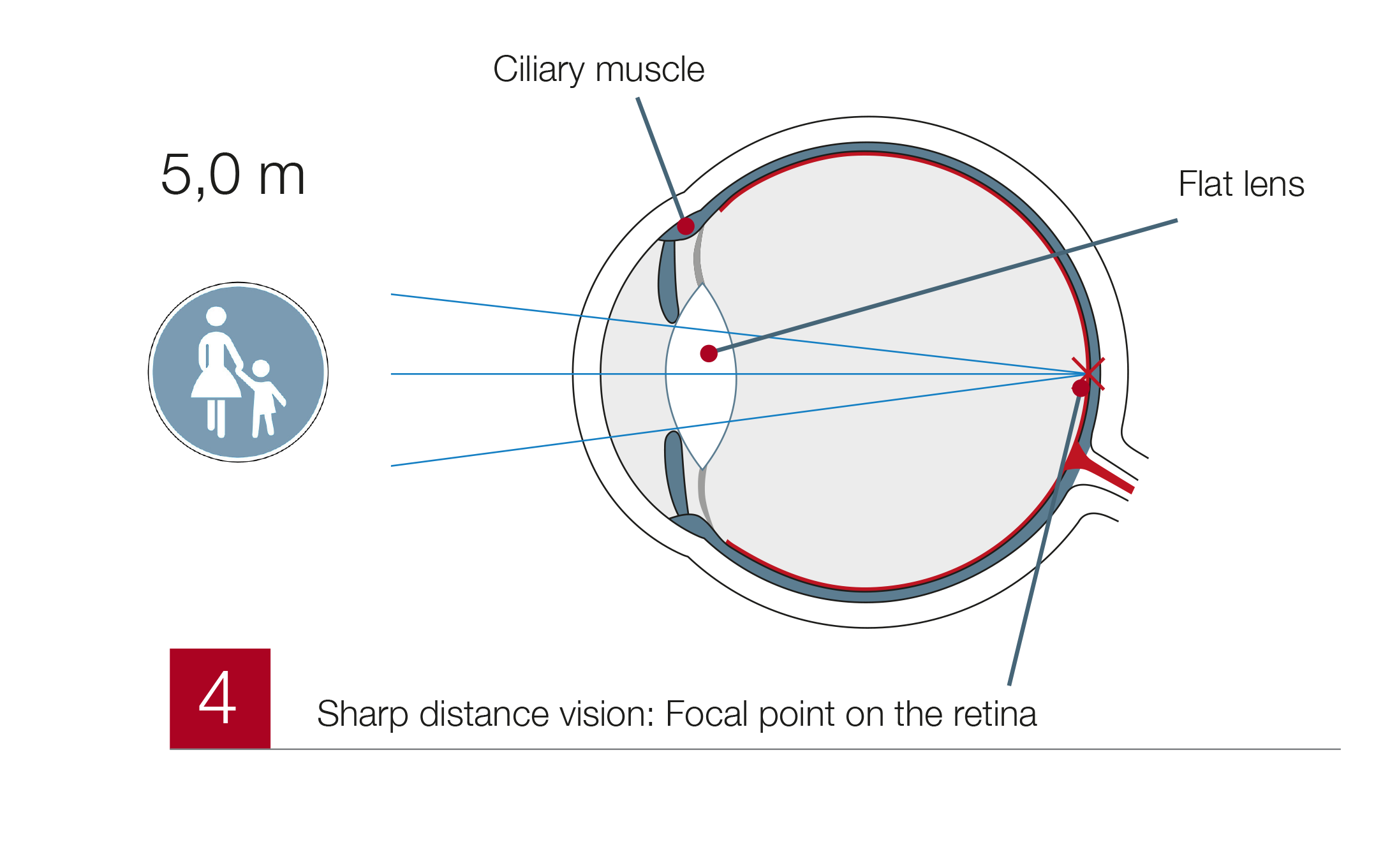 Presbyopia