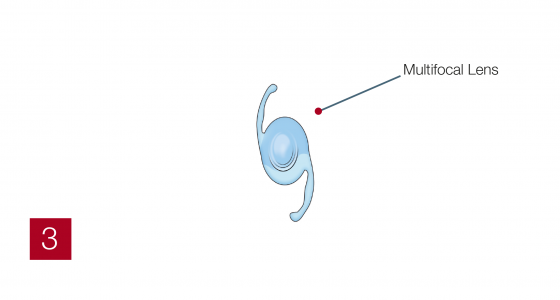 Multifocal3