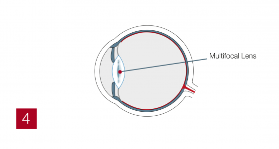 Multifocal4