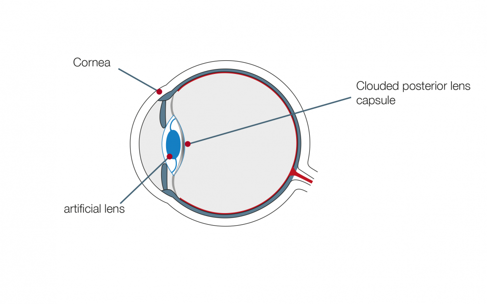 Multifocal_lenses5