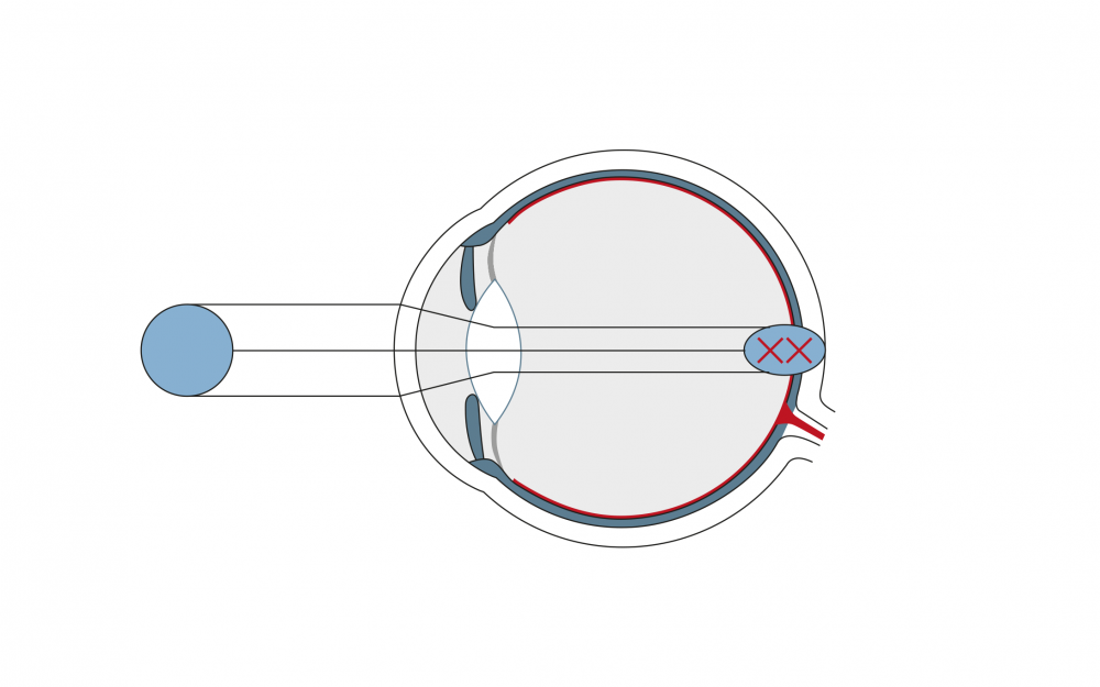 Exerciții de ochi pentru astigmatism cu miopie