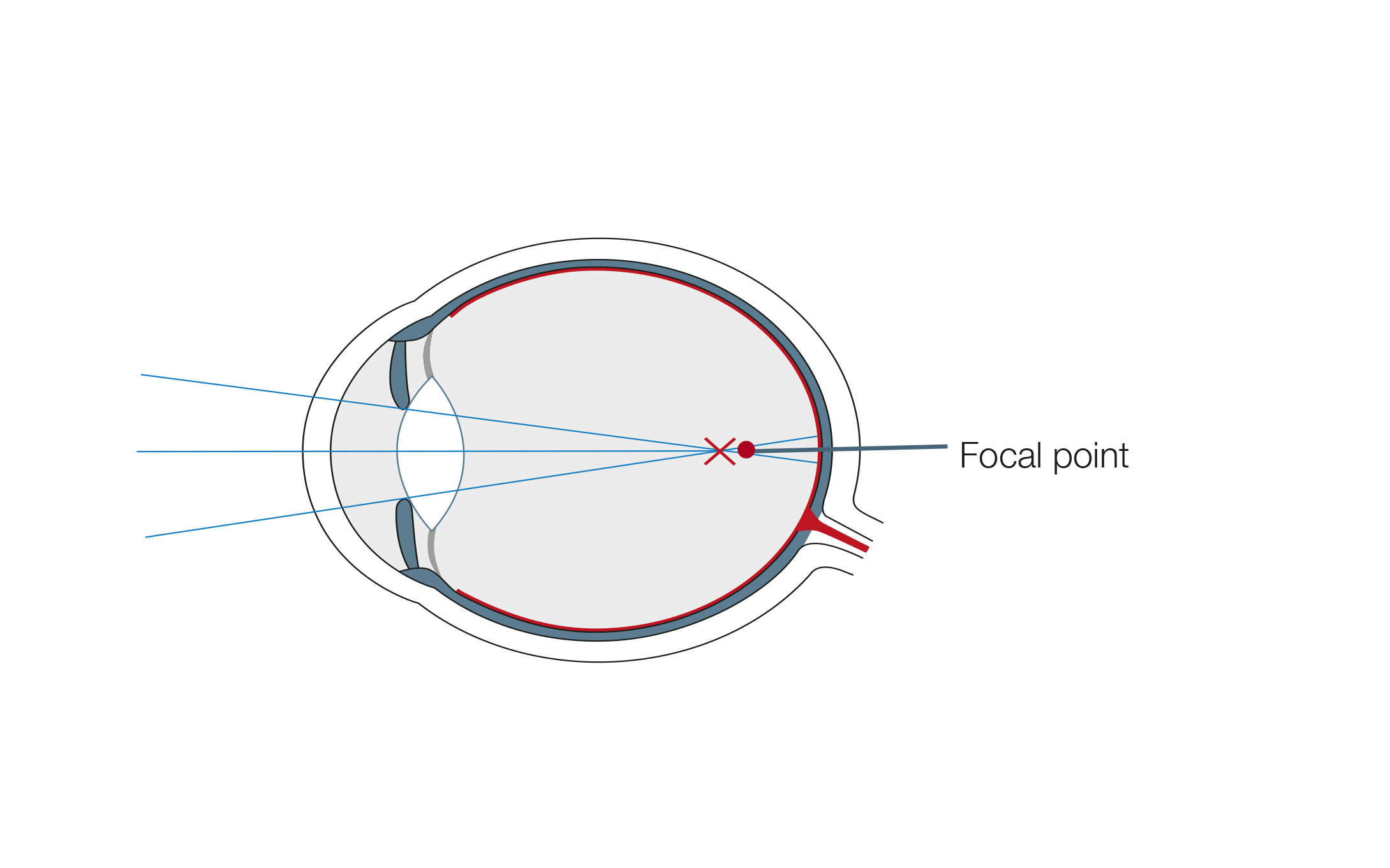 Nearsightedness Correction Treatment At Test Winner Euroeyes