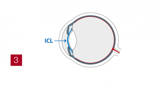 ICL3