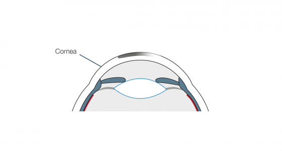 Femto-Lasik4